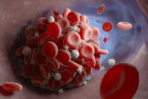 blood clot: thrombosis 